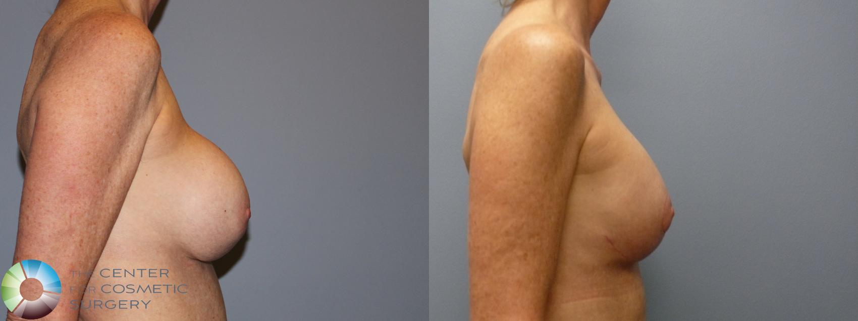 Before & After Breast Implant Revision Case 12045 Right Side in Denver and Colorado Springs, CO