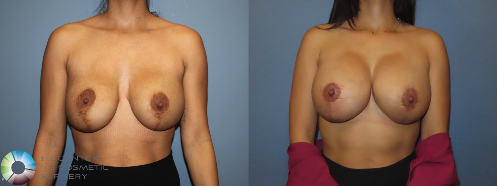 Before & After Breast Implant Revision Case 12156 Front in Denver and Colorado Springs, CO
