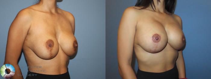 Best Denver Breast Implant Revision/Lift