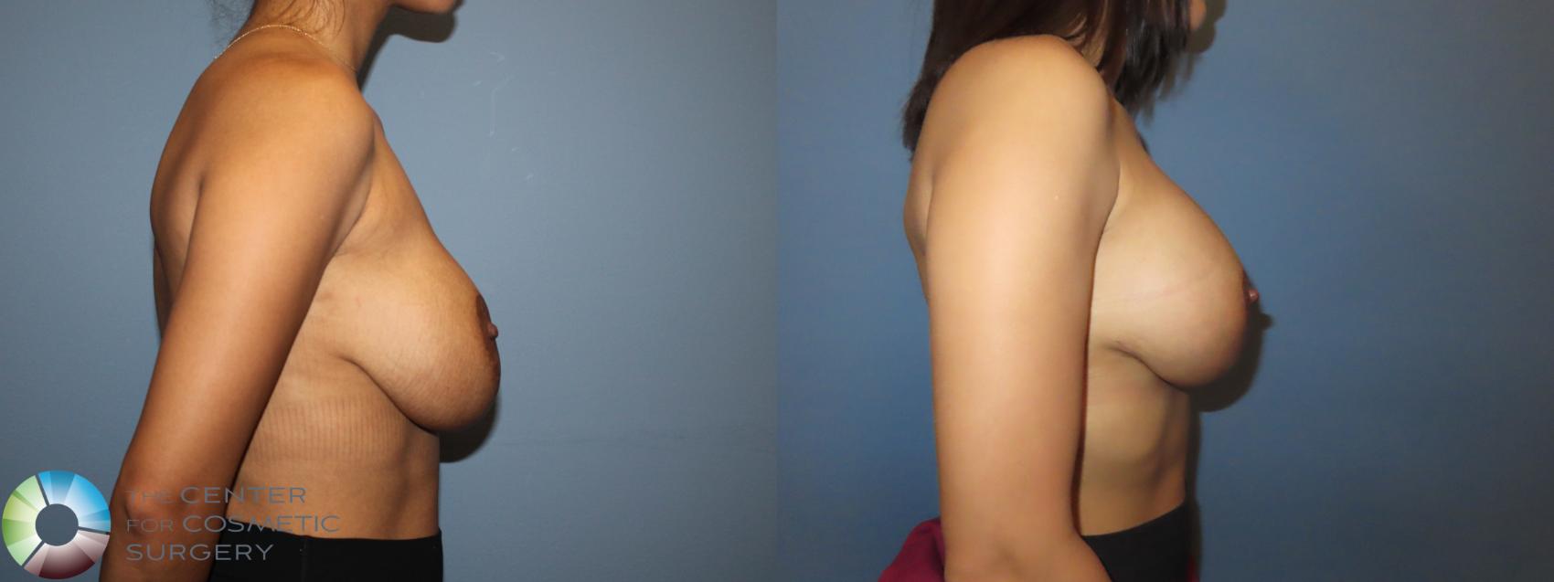 Before & After Breast Implant Revision Case 12156 Right Side in Denver and Colorado Springs, CO