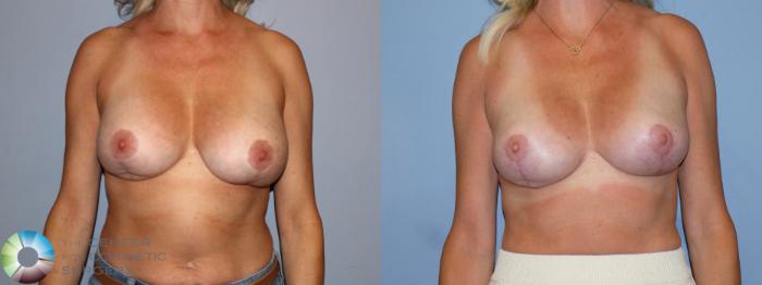 Before & After Breast Implant Revision Case 12171 Front in Denver and Colorado Springs, CO