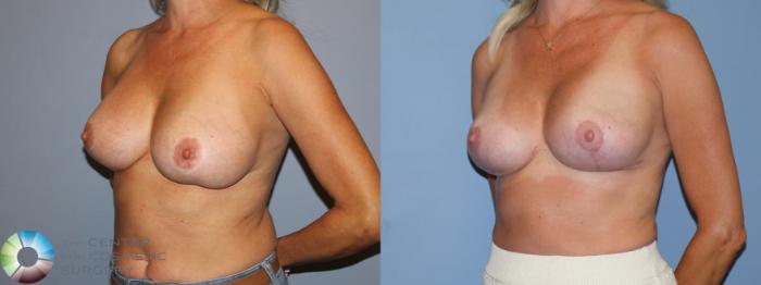 Before & After Breast Implant Revision Case 12171 Left Oblique in Denver and Colorado Springs, CO