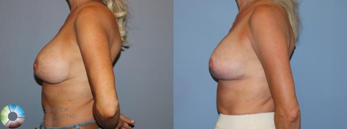 Before & After Breast Implant Revision Case 12171 Left Side in Denver and Colorado Springs, CO