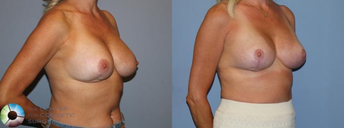 Before & After Breast Implant Revision Case 12171 Right Oblique in Denver and Colorado Springs, CO