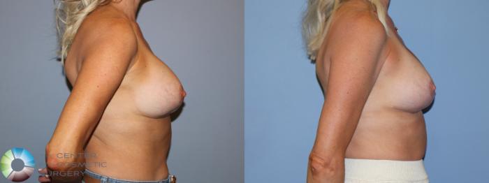 Before & After Breast Implant Revision Case 12171 Right Side in Denver and Colorado Springs, CO