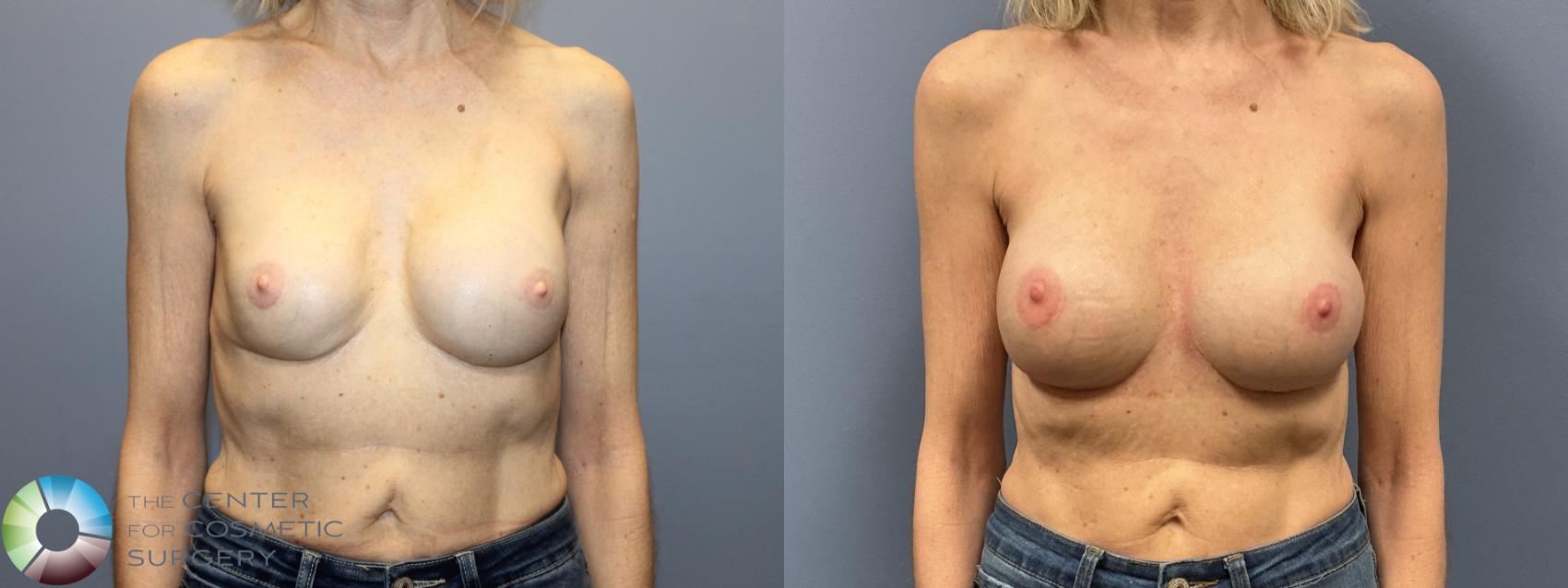 Before & After Breast Implant Revision Case 12236 Front in Denver and Colorado Springs, CO
