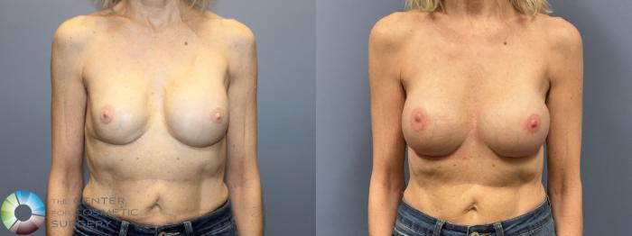 Before & After Breast Implant Revision Case 12236 Front in Denver and Colorado Springs, CO