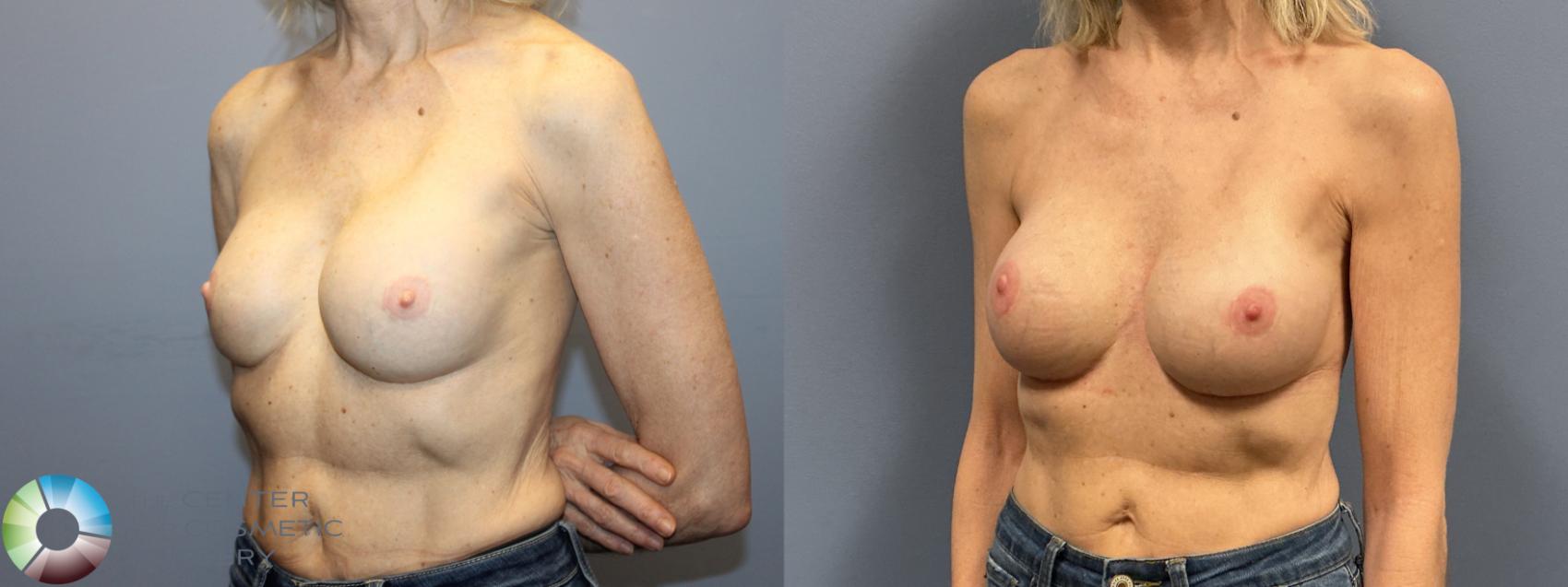Before & After Breast Implant Revision Case 12236 Left Oblique in Denver and Colorado Springs, CO
