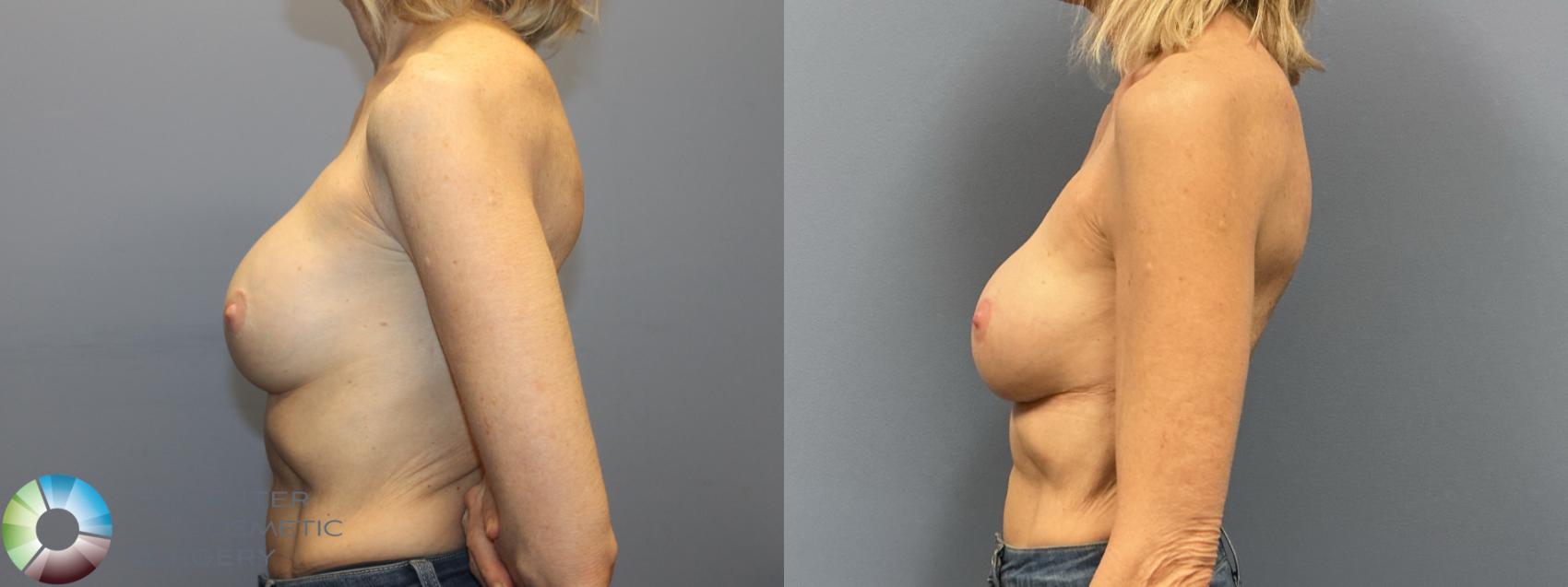 Before & After Breast Implant Revision Case 12236 Left Side in Denver and Colorado Springs, CO