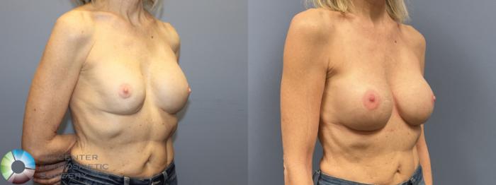 Before & After Breast Implant Revision Case 12236 Right Oblique in Denver and Colorado Springs, CO