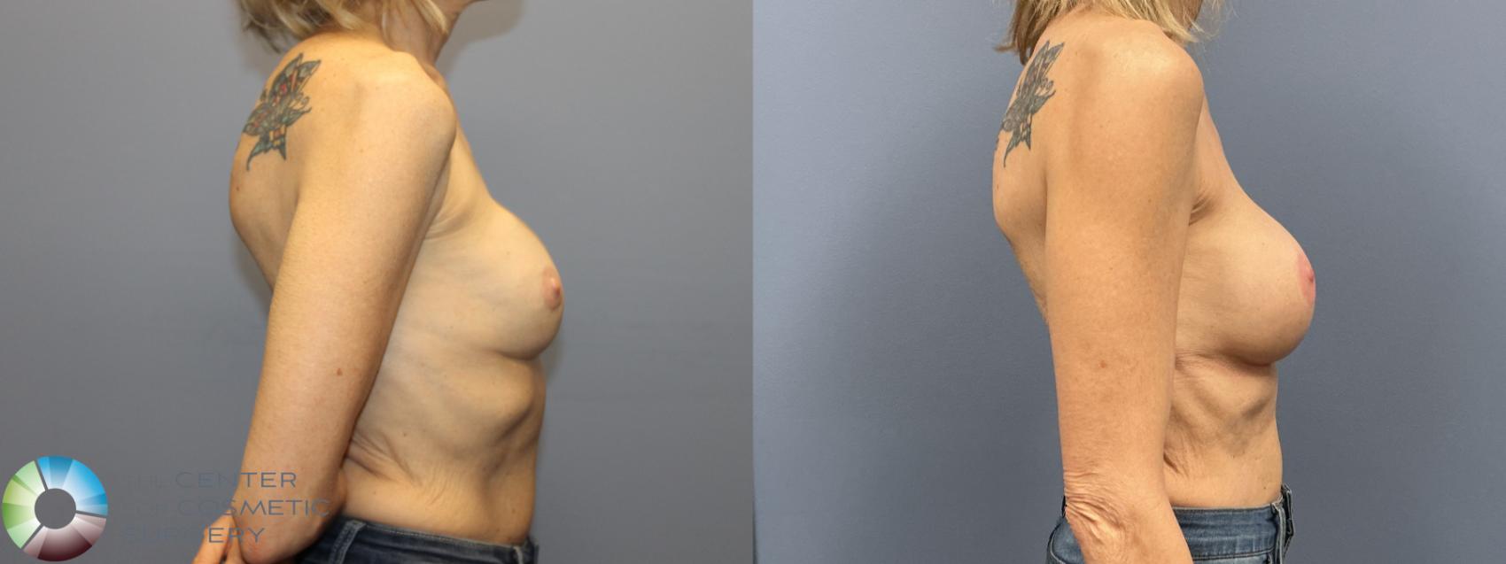 Before & After Breast Implant Revision Case 12236 Right Side in Denver and Colorado Springs, CO
