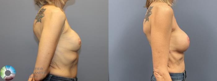 Before & After Breast Implant Revision Case 12236 Right Side in Denver and Colorado Springs, CO