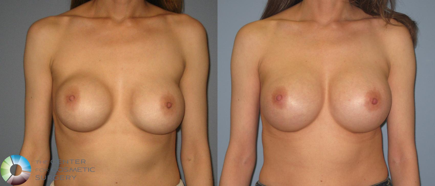 Before & After Breast Implant Revision Case 398 View #1 View in Golden, CO