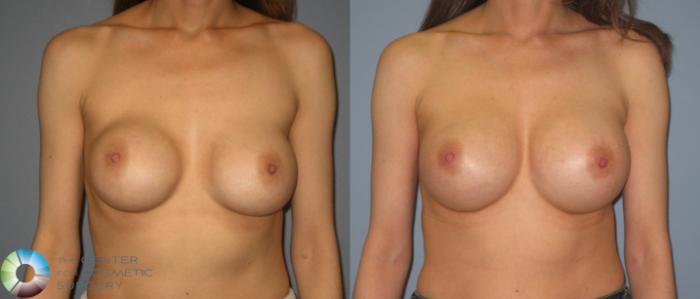 Before & After Breast Implant Revision Case 398 View #1 in Denver and Colorado Springs, CO