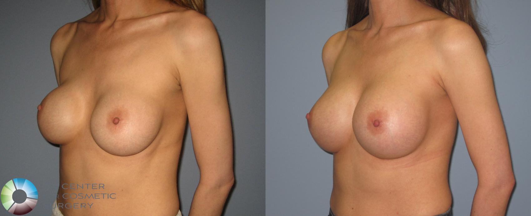 Before & After Breast Implant Revision Case 398 View #2 View in Golden, CO