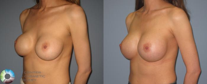 Before & After Breast Implant Revision Case 398 View #2 in Denver and Colorado Springs, CO