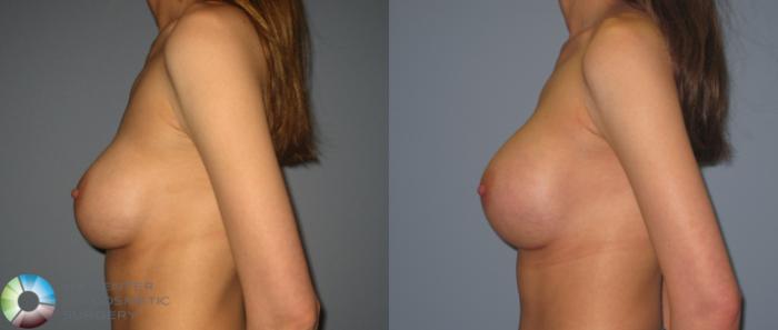 Before & After Breast Implant Revision Case 398 View #3 in Denver and Colorado Springs, CO