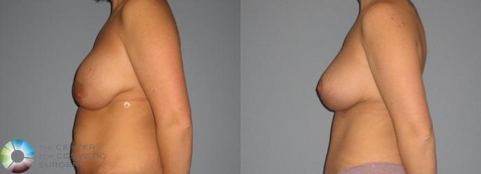 Before & After Breast Implant Revision Case 402 View #1 in Denver, CO