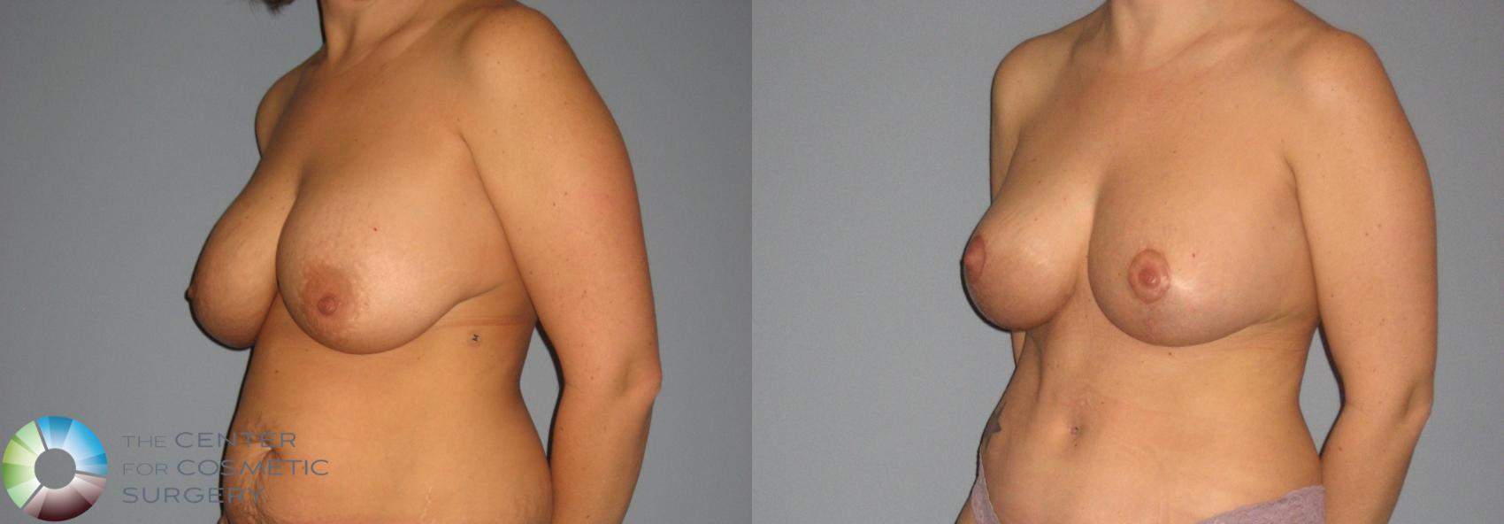 Before & After Breast Implant Revision Case 402 View #2 View in Golden, CO