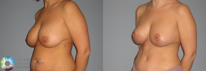 Before & After Breast Implant Revision Case 402 View #2 in Denver, CO