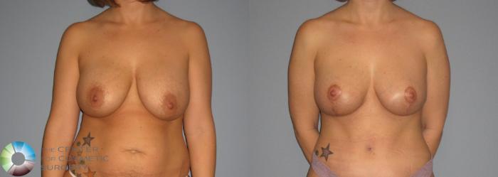 Before & After Breast Implant Revision Case 402 View #3 in Denver, CO