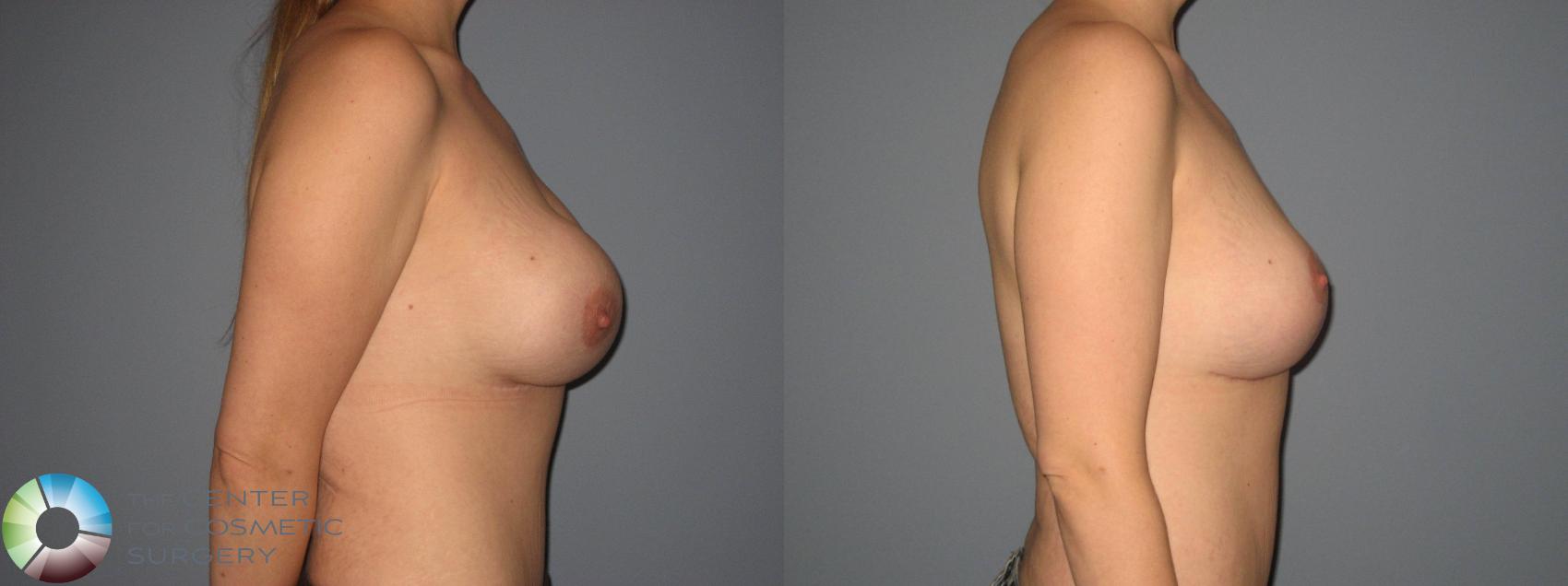 Before & After Breast Implant Revision Case 404 View #1 View in Golden, CO