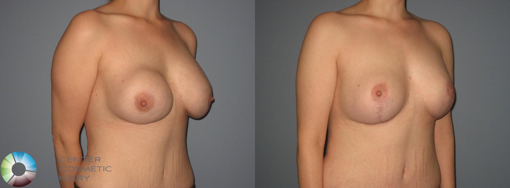 Before & After Breast Implant Revision Case 404 View #2 in Denver and Colorado Springs, CO