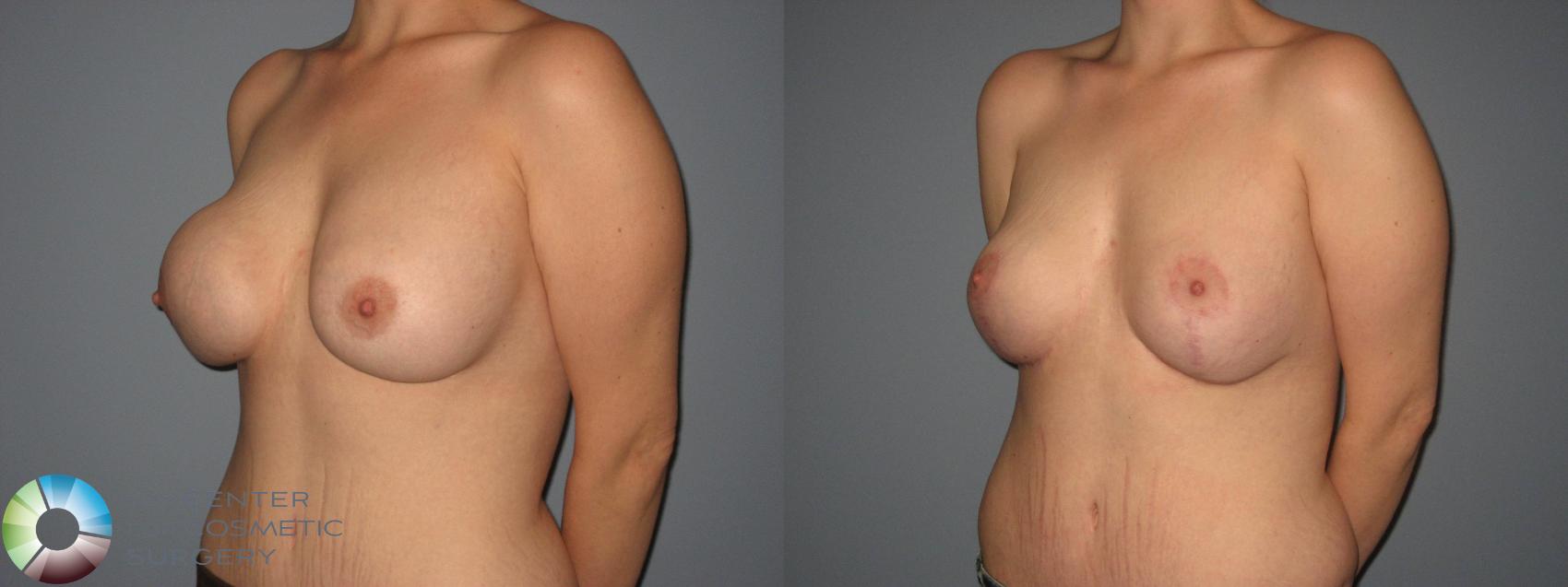Before & After Breast Implant Revision Case 404 View #3 in Denver and Colorado Springs, CO