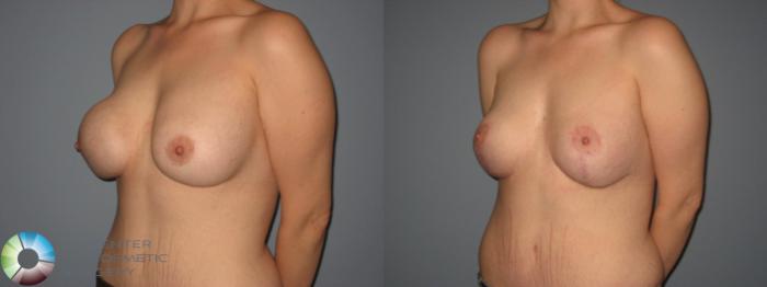 Before & After Breast Implant Revision Case 404 View #3 View in Golden, CO