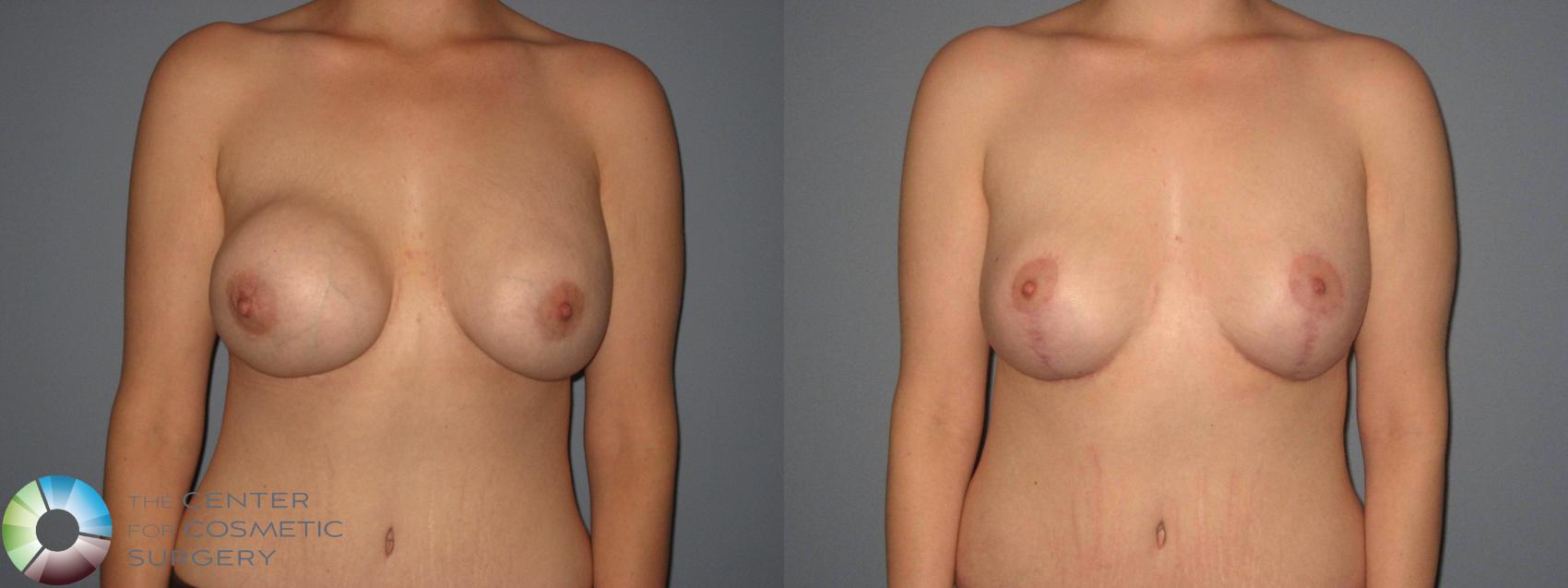 Before & After Breast Implant Revision Case 404 View #4 in Denver and Colorado Springs, CO