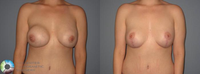 Before & After Breast Implant Revision Case 404 View #4 View in Golden, CO