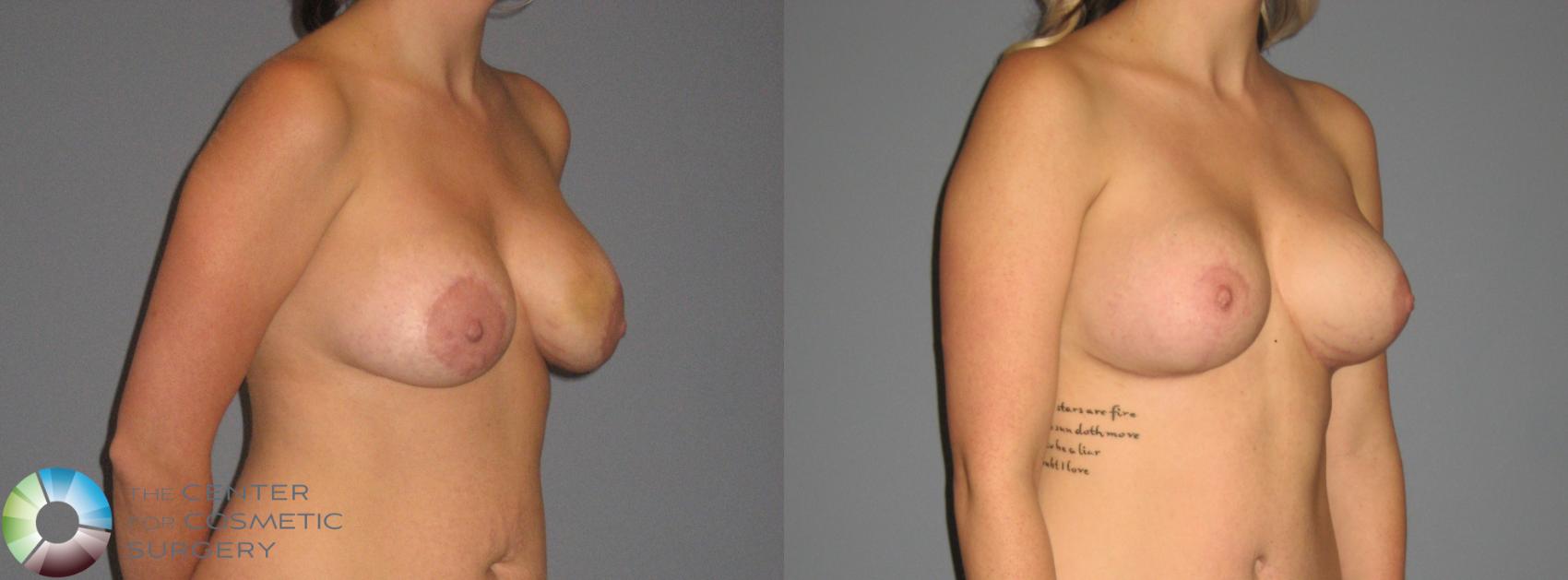 Before & After Breast Implant Revision Case 448 View #1 in Denver and Colorado Springs, CO