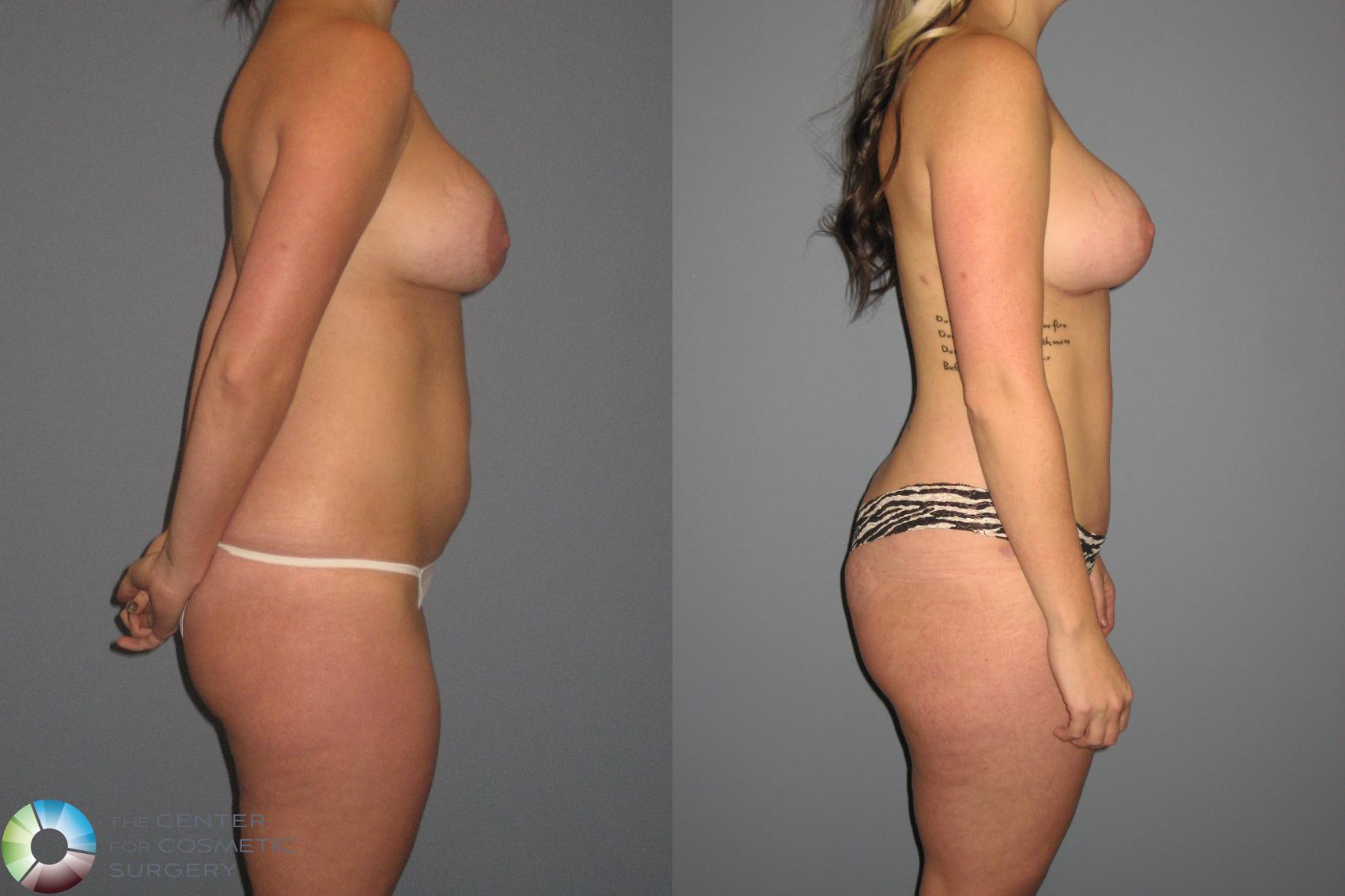 Before & After Breast Implant Revision Case 448 View #2 View in Golden, CO