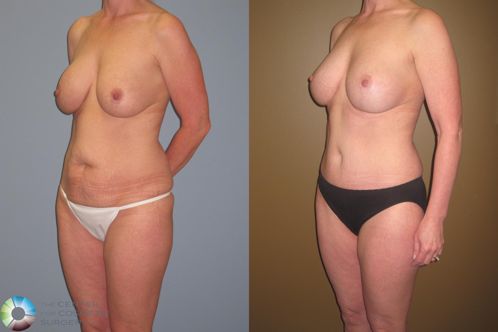 Before & After Breast Lift Case 467 View #1 View in Golden, CO
