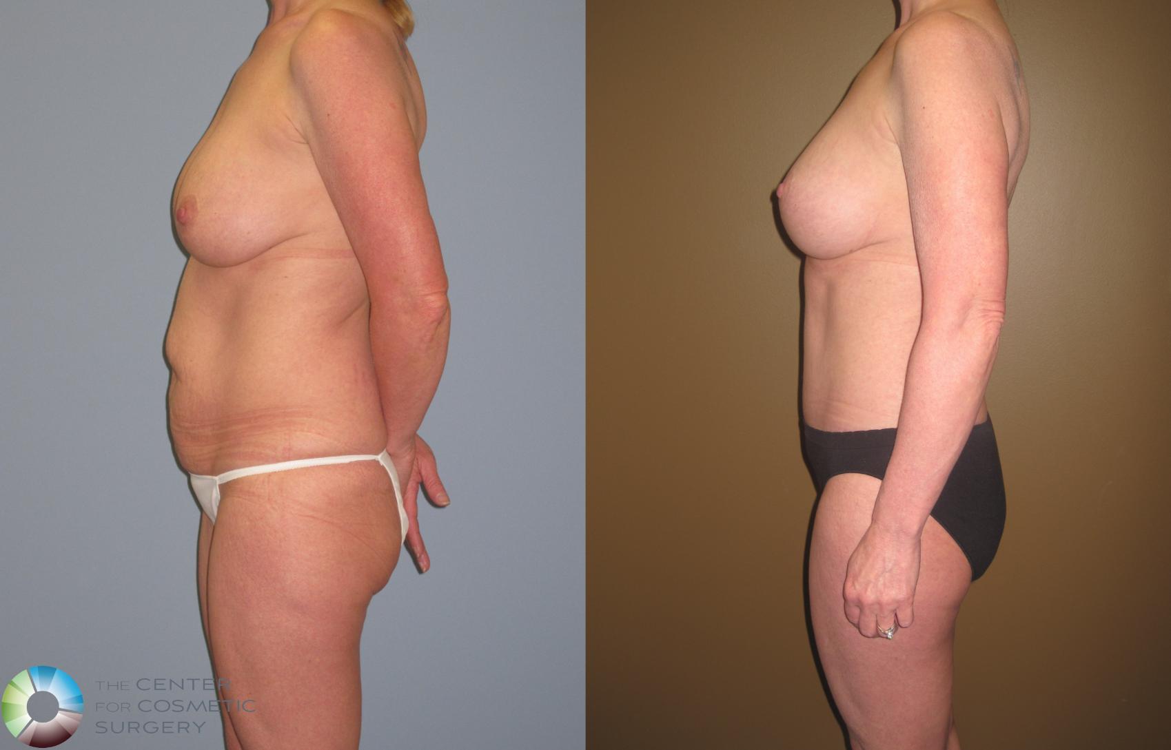 Before & After Breast Implant Revision Case 467 View #2 in Denver and Colorado Springs, CO