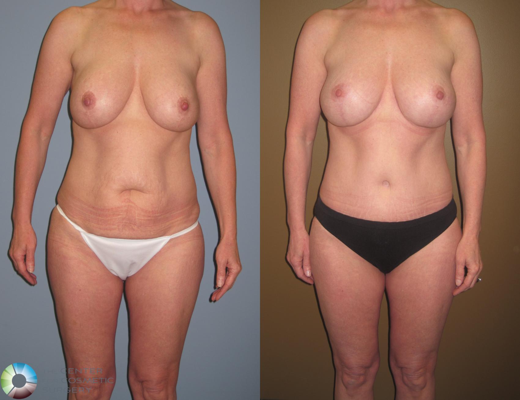Before & After Breast Implant Revision Case 467 View #3 in Denver and Colorado Springs, CO
