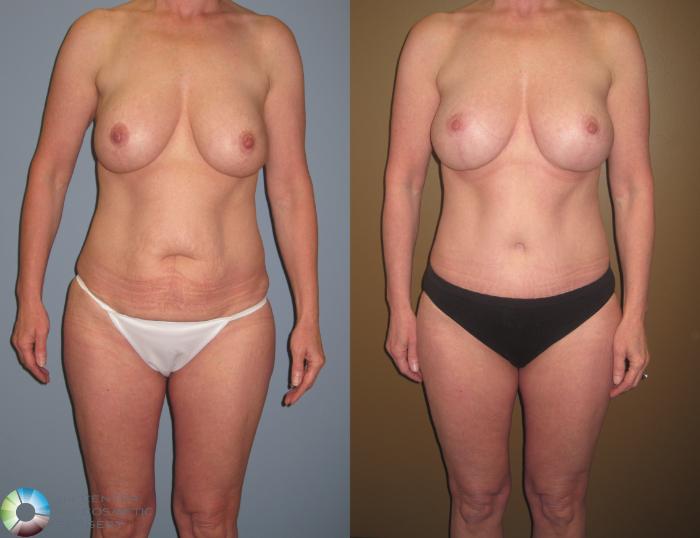 Before & After Breast Lift Case 467 View #3 View in Golden, CO