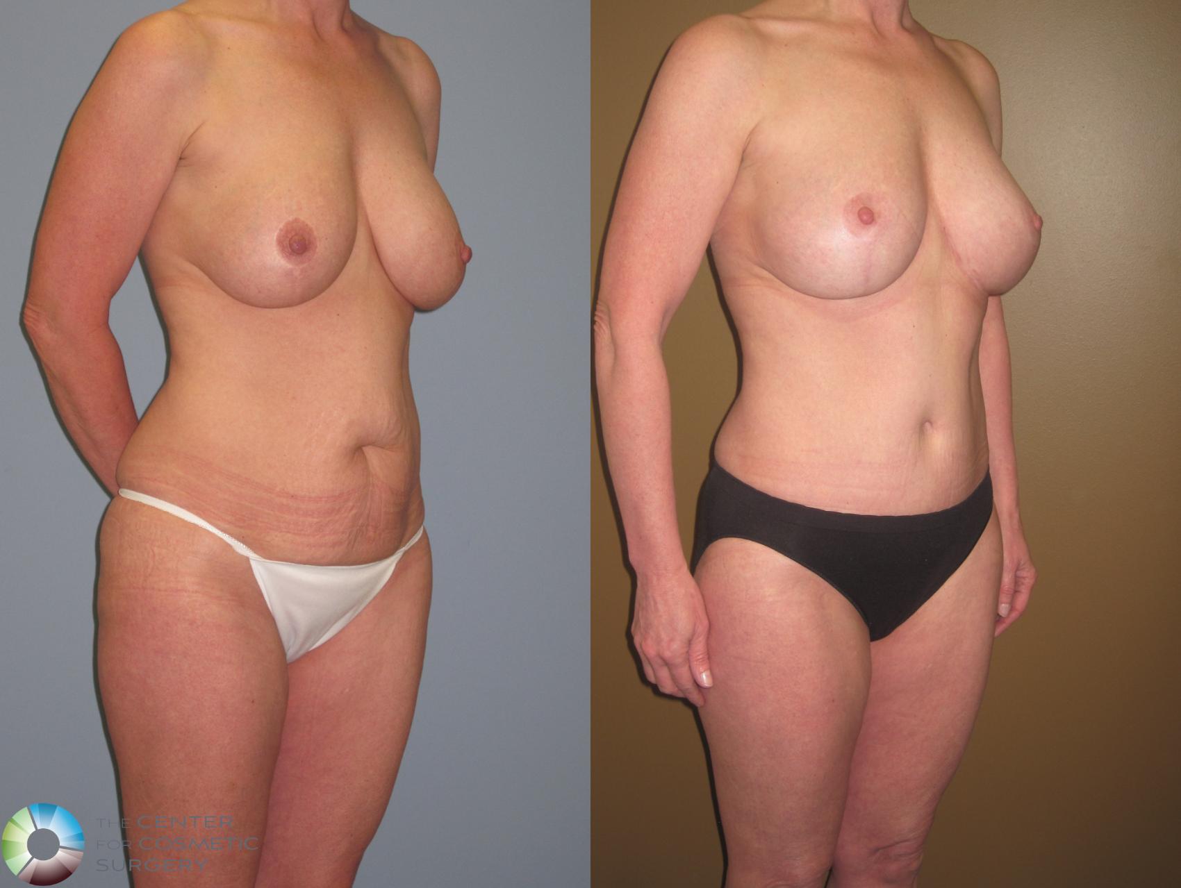 Before & After Breast Implant Revision Case 467 View #4 in Denver and Colorado Springs, CO
