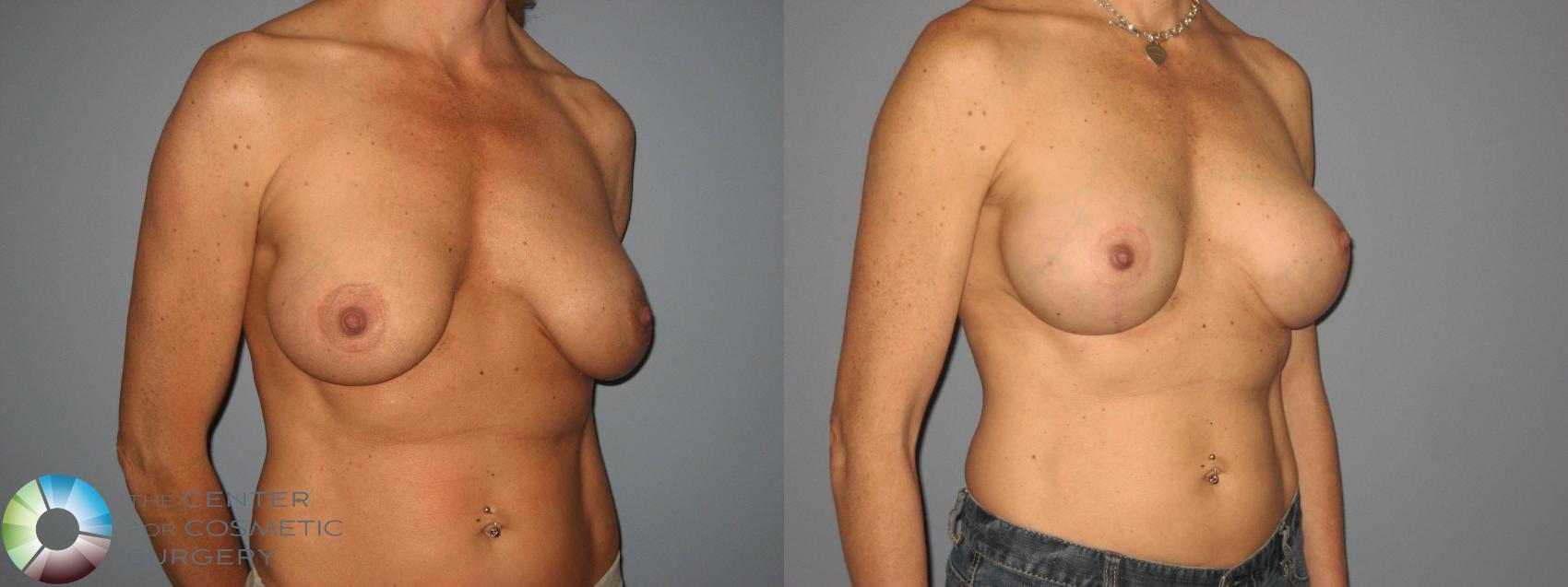 Before & After Breast Implant Revision Case 474 View #1 in Denver and Colorado Springs, CO