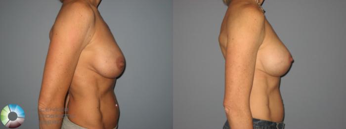Before & After Breast Implant Revision Case 474 View #2 in Denver, CO