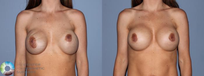 Before & After Breast Implant Revision Case 488 View #1 View in Golden, CO