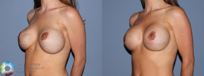 Before & After Breast Implant Revision Case 488 View #2 View in Golden, CO