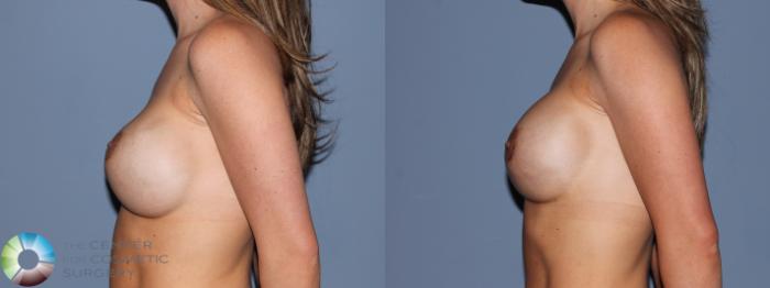Before & After Breast Implant Revision Case 488 View #3 View in Golden, CO