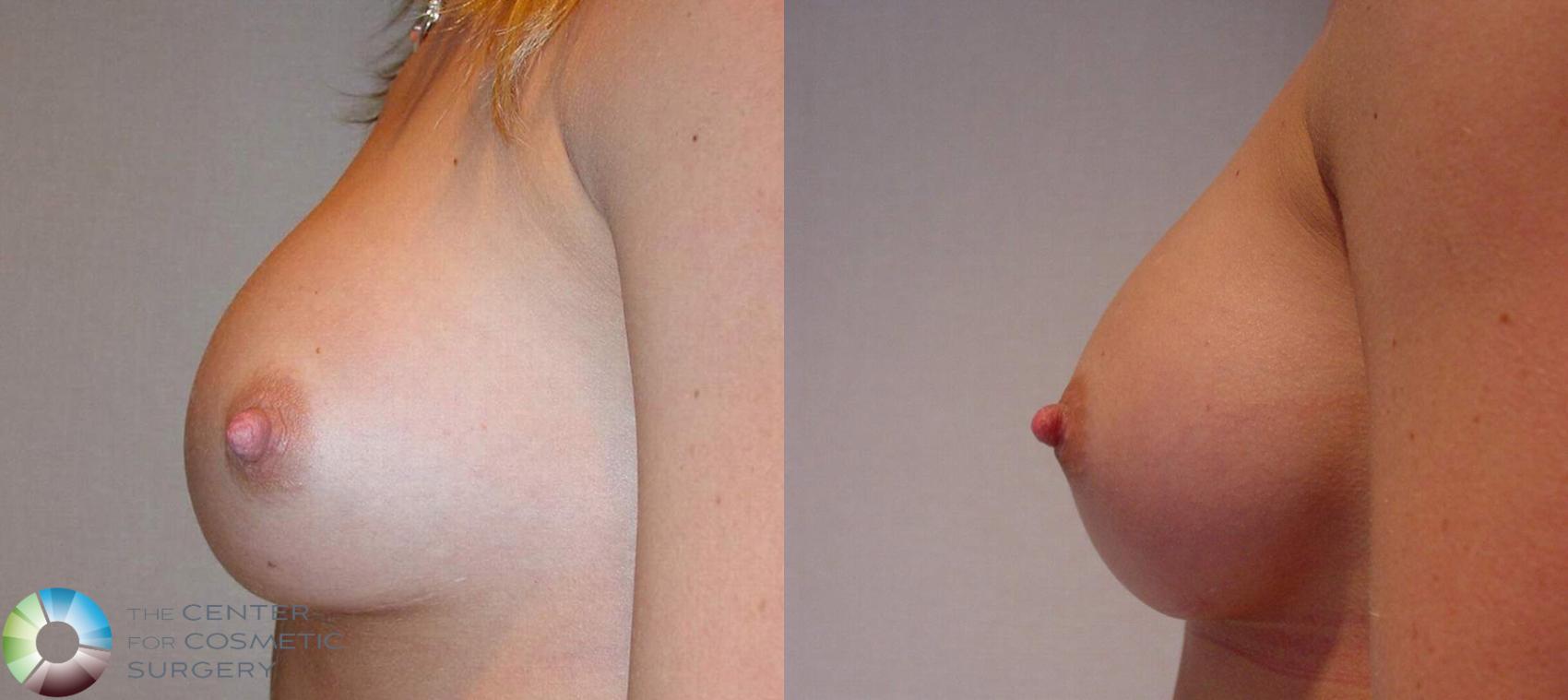 Before & After Breast Implant Revision Case 503 View #2 View in Golden, CO