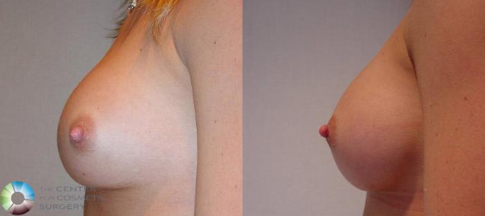 Before & After Breast Implant Revision Case 503 View #2 in Denver, CO