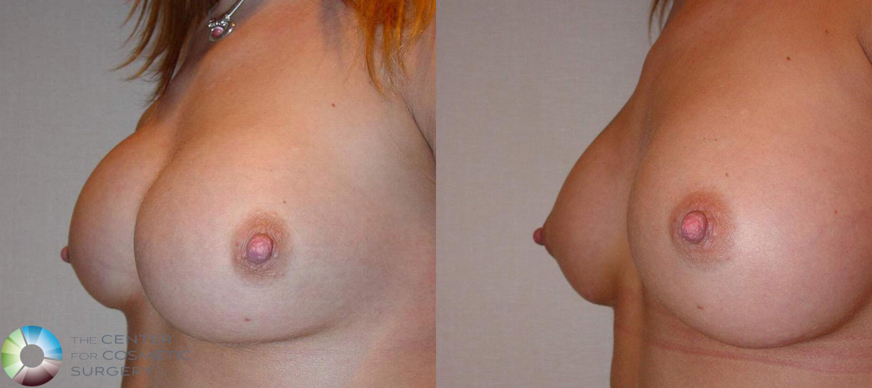 Before & After Breast Implant Revision Case 503 View #3 View in Golden, CO