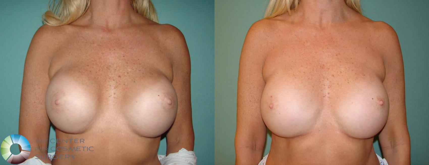 Before & After Breast Implant Revision Case 600 View #1 in Denver and Colorado Springs, CO