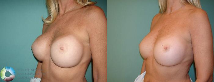 Before & After Breast Implant Revision Case 600 View #2 View in Golden, CO