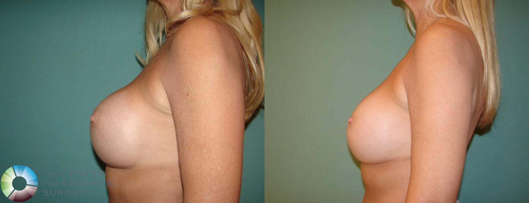 Before & After Breast Implant Revision Case 600 View #3 in Denver and Colorado Springs, CO