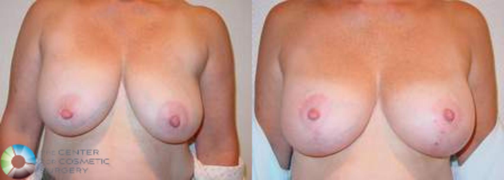 Before & After Breast Implant Revision Case 626 View #1 View in Golden, CO